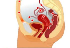 Lạc nội mạc tử cung có thể gây vô sinh