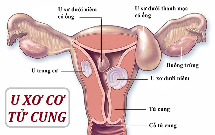 U xơ cơ tử cung – Bệnh phụ phổ biến ở nữ giới