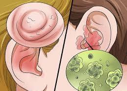 Nhiễm trùng tai là nguyên nhân gây triệu chứng ù tai