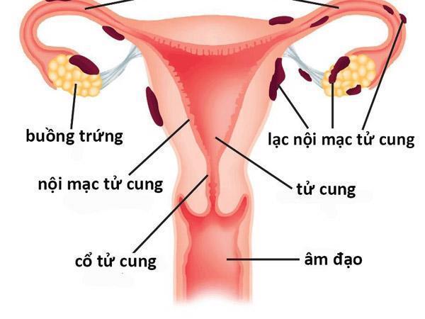 Hình ảnh minh họa tình trạng lạc nội mạc tử cung