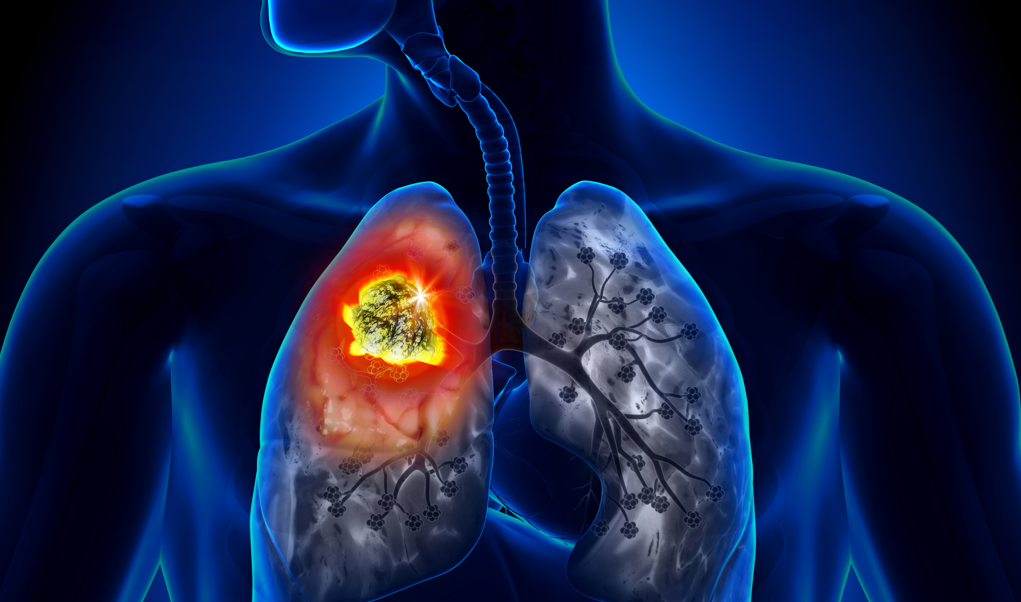 Khối u ở phổi là bệnh gì?