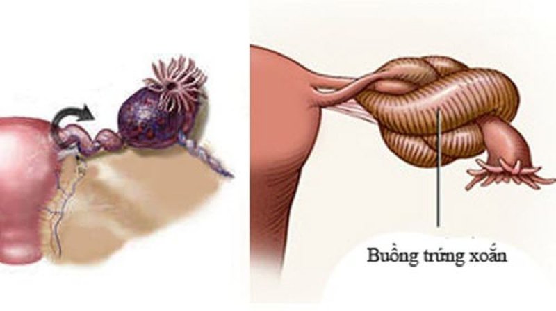Xoắn u nang là dạng hay gặp khi mắc phải u nang buồng trứng