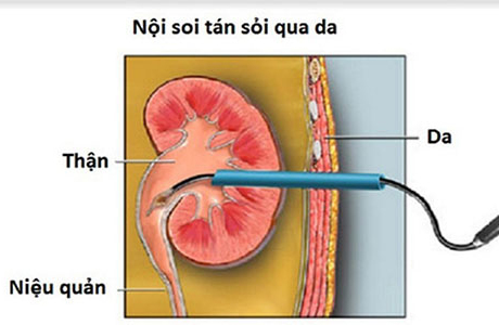 Hình ảnh minh họa mổ nội soi sỏi thận qua da