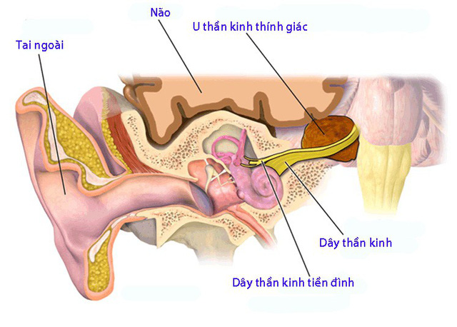 U dây thần kinh âm thanh dễ gây điếc tai