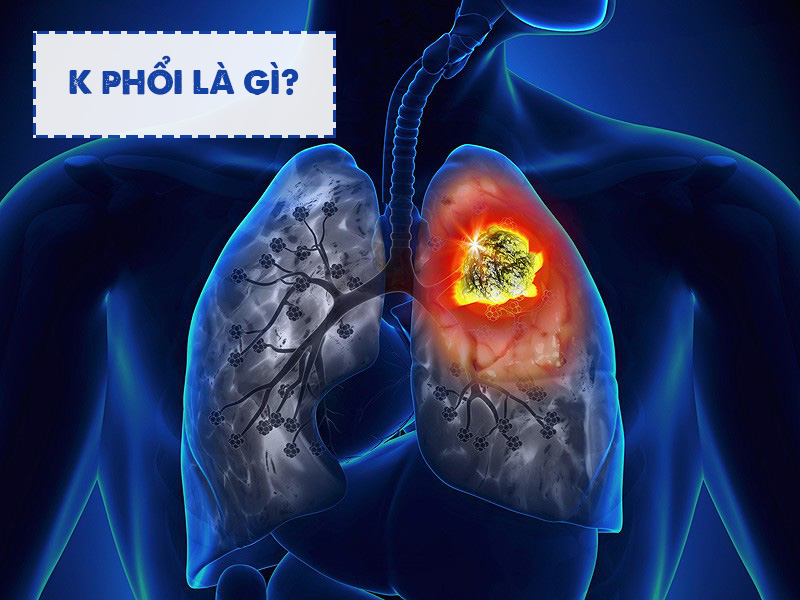 K phổi là bệnh lý nguy hiểm cần được điều trị sớm