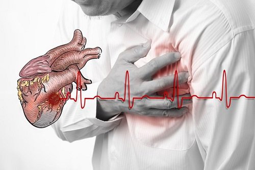 Mỡ máu cao có thể làm tăng nguy cơ bị nhồi máu cơ tim