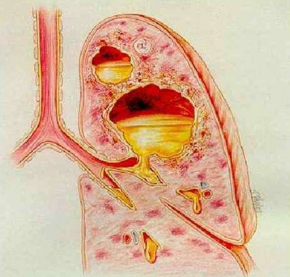  Áp xe phổi do viêm phổi
