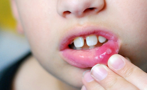  Viêm loét miệng lưỡi là tình trạng phổ biến ở trẻ em