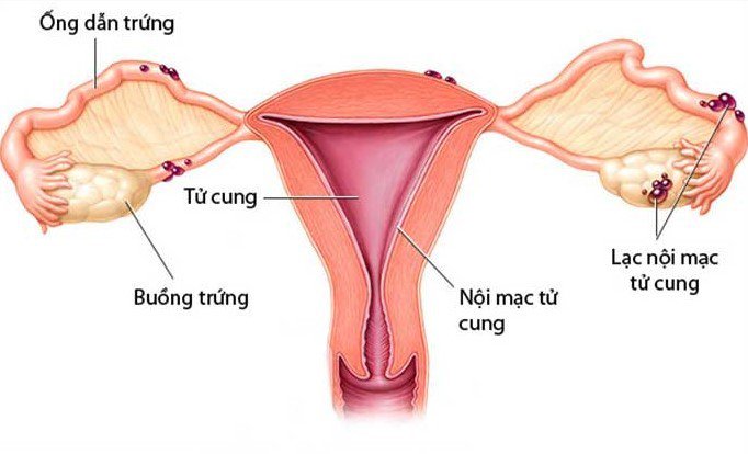  Đau bụng khi đến tháng có thể là dấu hiệu cảnh báo bệnh lạc nội mạc tử cung