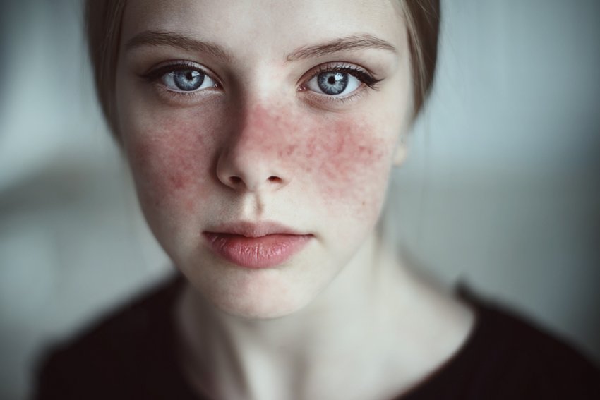  Hình ảnh bệnh lupus ban đỏ