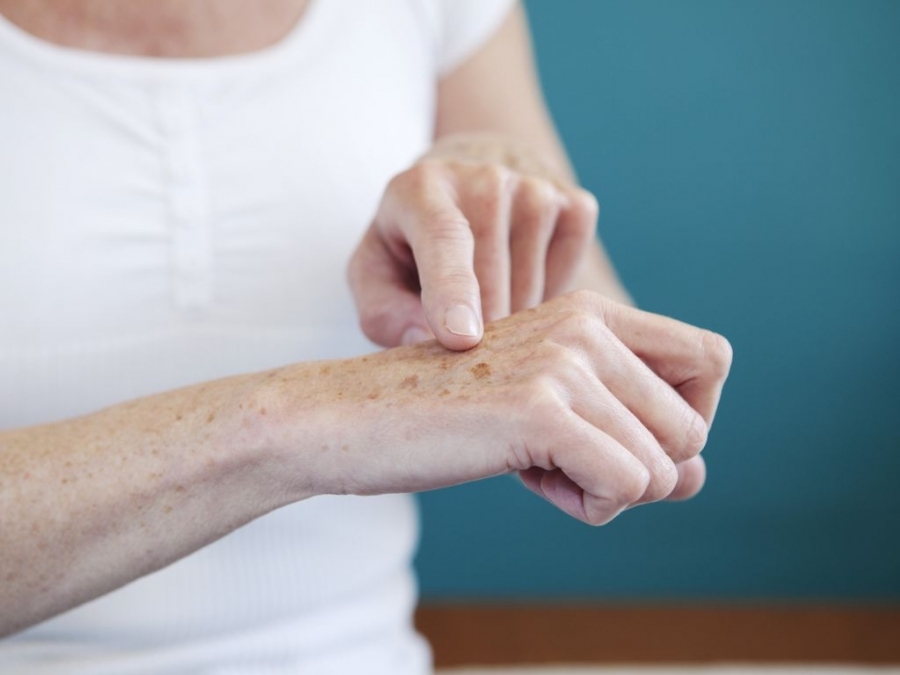  Nám da tay xảy ra khi tiếp xúc nhiều với ánh nắng mặt trời