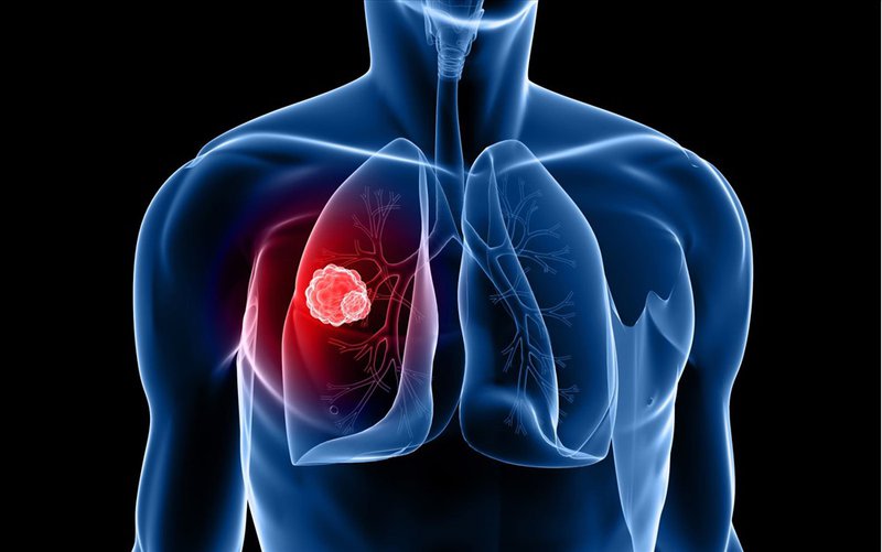  U phổi bao gồm u phổi ác tính và lành tính