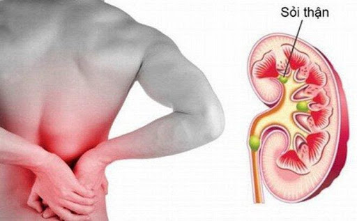  Cơn đau do sỏi thận thường xuất hiện ở vùng hố thắt lưng