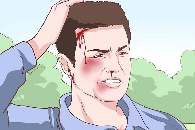  Chấn thương tại vùng đầu có thể khiến bạn bị ù tai phải kéo dài