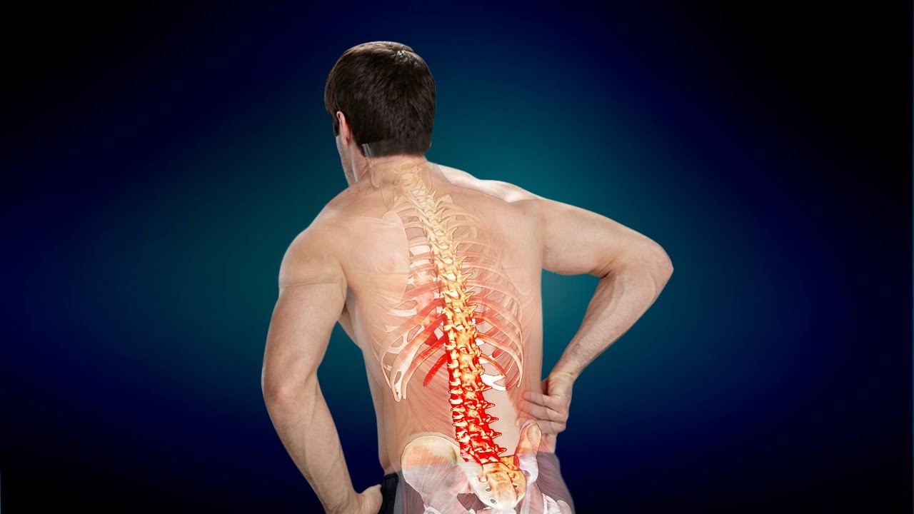  Bệnh nhân có thể bị đau thắt lưng sau mổ thoát vị đĩa đệm lần 2