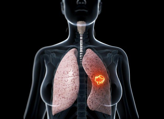  U phổi lành tính không di căn
