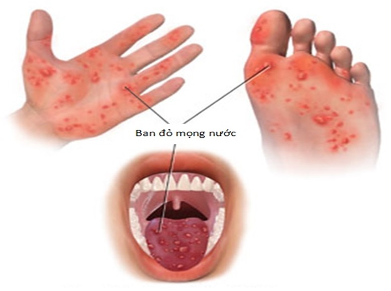  Bệnh tay chân miệng đặc trưng bởi những bóng nước ở miệng, bàn tay, bàn chân