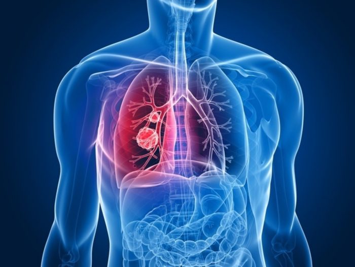  U phổi lành tính đang ngày càng trở nên phổ biến