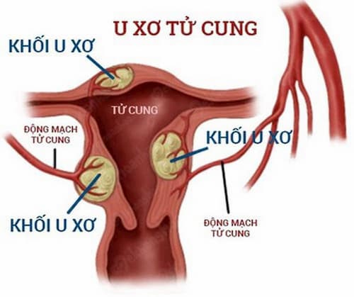 U xơ tử cung rất dễ tái phát sau phẫu thuật