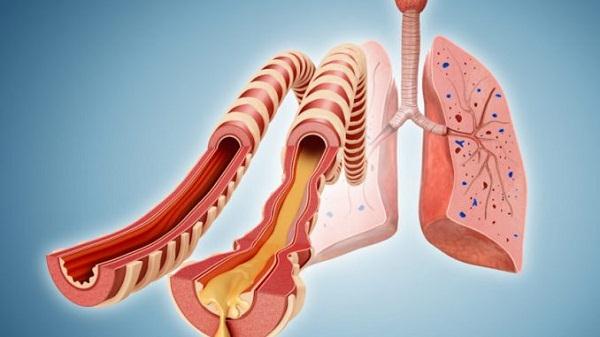   Ho khan, ngứa cổ là triệu chứng của bệnh viêm phổi, viêm phế quản do tái cấu trúc đường thở gây ra