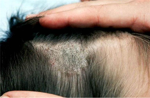 Triệu chứng á sừng vảy nến da đầu