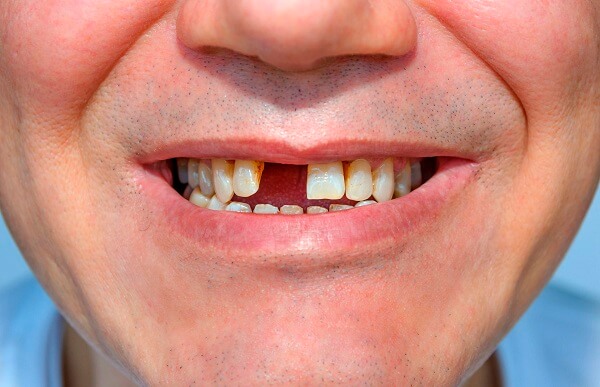   Viêm lợi sưng hàm có thể dẫn tới mất răng