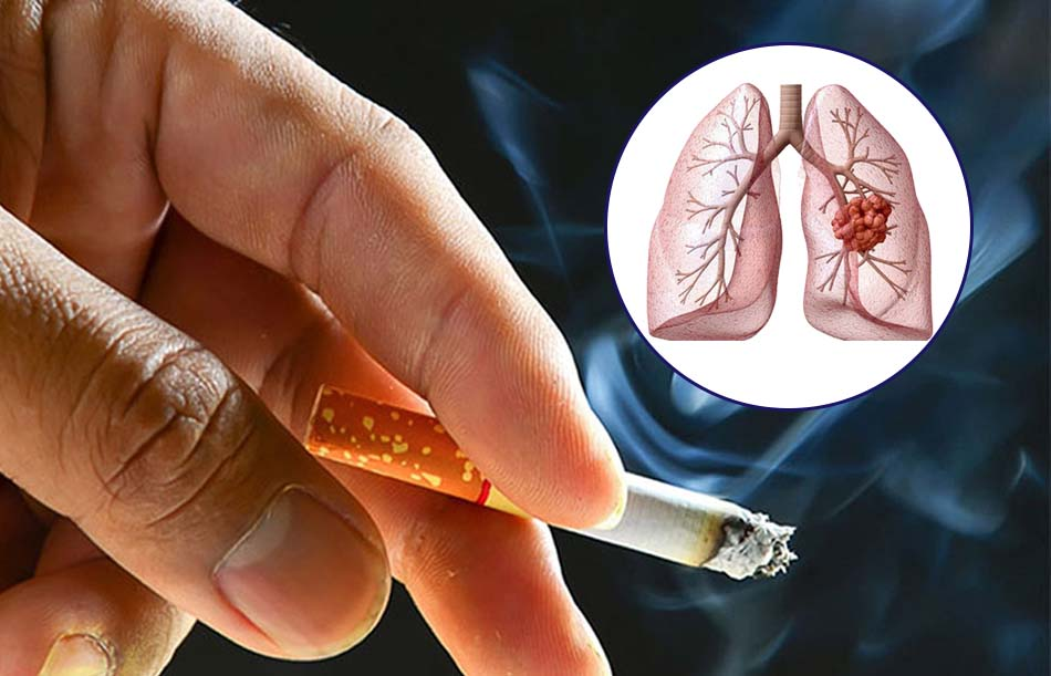 Có nhiều nguyên nhân khác nhau gây ung thư phổi