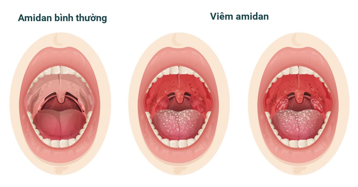 Viêm amidan là bệnh đường hô hấp trên phổ biến