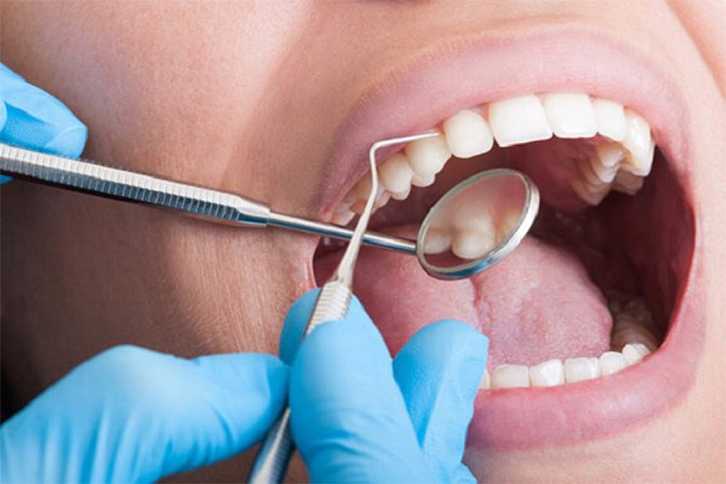   Thao tác thiếu chính xác có thể gây viêm quanh cuống răng
