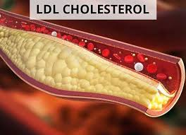 LDL - cholesterol tăng trong máu dẫn đến lắng đọng ở thành mạch máu