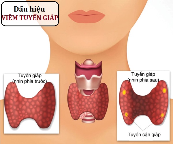 Viêm tuyến giáp sau sinh: Nguyên nhân, Triệu chứng và Cách điều trị hiệu quả