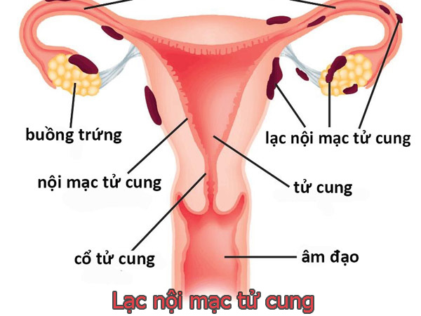 Socola Giúp Giảm Đau Bụng Kinh: Bí Quyết Tự Nhiên Cho Phụ Nữ