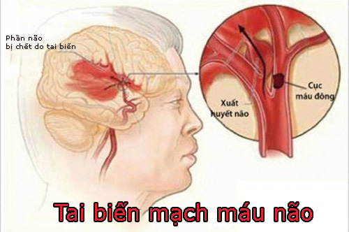 Người bị bệnh tai biến mạch máu não kiêng ăn gì. Xem ngay TẠI ĐÂY!