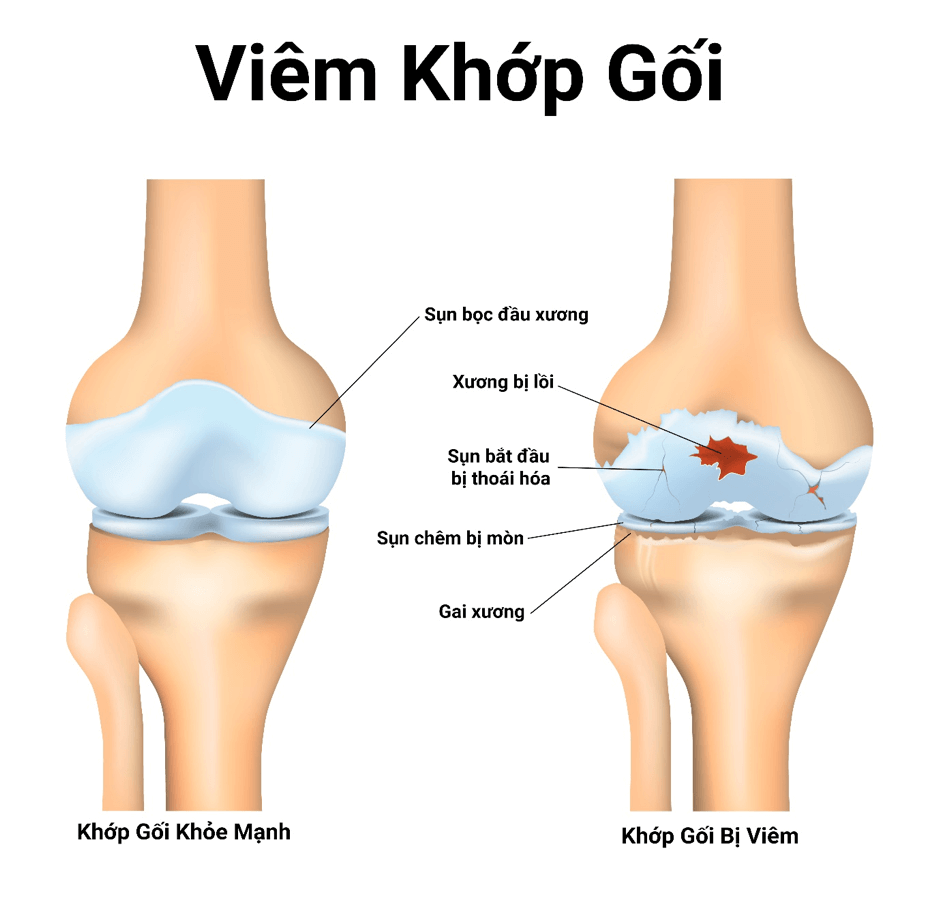 Phương pháp điều trị viêm khớp gối tràn dịch