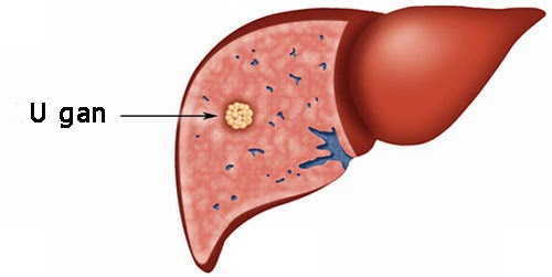 Thông tin về u gan lành tính và thời gian sống