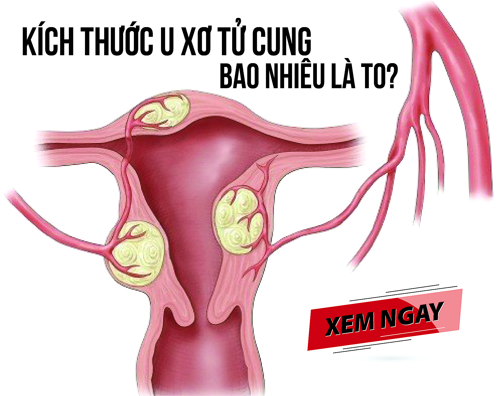 Nhân Xơ Tử Cung Bao Nhiêu Là Lớn? Cách Nhận Biết Và Điều Trị Hiệu Quả