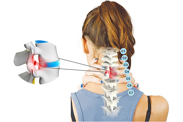 Thoát vị đĩa đệm cổ C4 C5 - TẤT TẦN TẬT những điều cần phải biết!