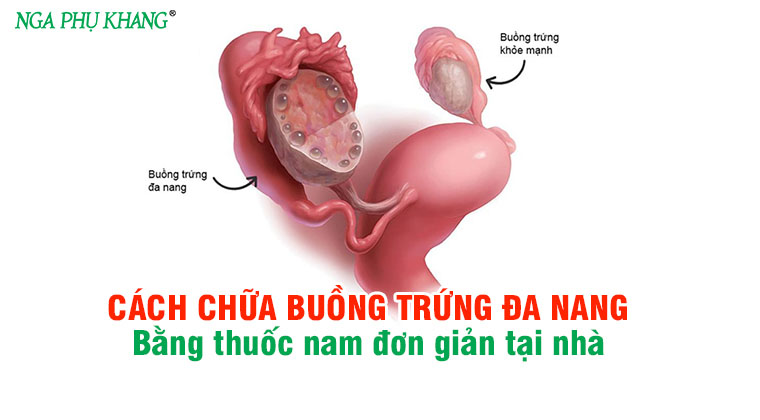 Trinh nữ hoàng cung có thể được sử dụng cho tất cả các trường hợp đa nang buồng trứng hay chỉ áp dụng cho những trường hợp cụ thể?
