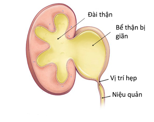 3. Triệu chứng của giãn đài bể thận