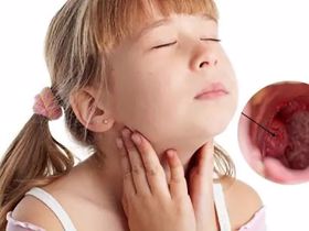 Tìm hiểu về viêm họng mủ ở trẻ em và cách khắc phục hiệu quả
