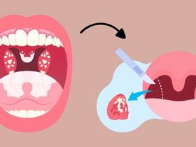 Tại sao sau cắt amidan vẫn bị đau họng?