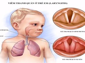 Viêm thanh quản ở trẻ em có nguy hiểm không? Đối phó ra sao?