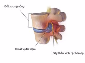 Nhận biết và điều trị thoát vị đĩa đệm