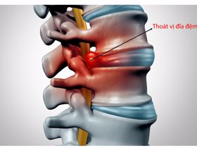 Thoát vị đĩa đệm - nguyên nhân phổ biến gây đau lưng