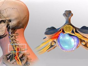 Nguy cơ tàn phế do thoát vị đĩa đệm cột sống cổ