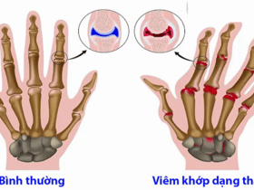 Làm gì khi bị viêm khớp dạng thấp?