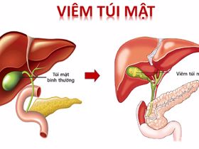 Viêm túi mật cấp nguyên nhân do đâu?