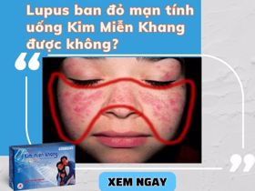 Lupus ban đỏ mạn tính có dùng được Kim Miễn Khang không?