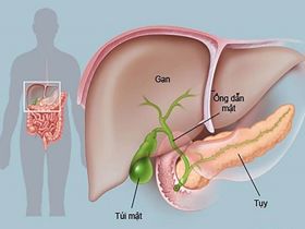 Nguyên nhân gây bệnh ung thư ống mật là gì?