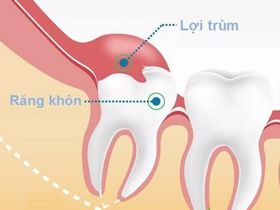 Viêm lợi trùm răng khôn - Giải pháp cải thiện là gì?